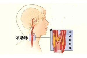 如何与颈动脉斑块和平共处？