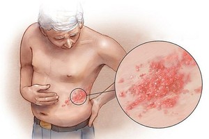 带状皰疹发病率高，积极防治不能少