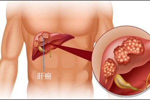 肝癌病人注意事项