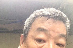 男子右腮患恶瘤