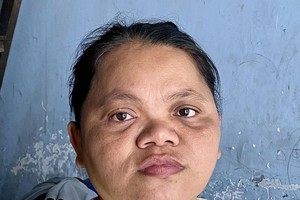 患脑瘤女子无钱医治