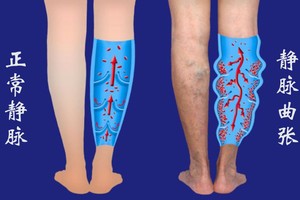 久坐、不常运动、水喝不够等是容易导致静脉曲张的原因。