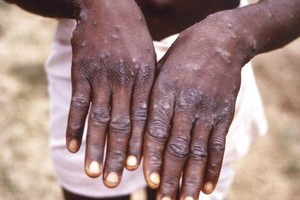 猴痘患者。（图：AP）