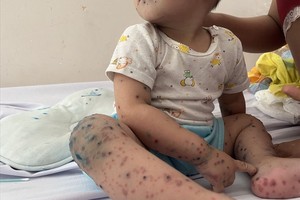 图为一名住院治疗的手足口病患儿。（图：阮莉）