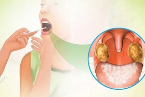 若出现疑似白喉的症状时，最好需去医疗单位以及时治疗。