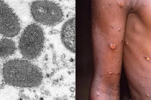 非洲疾控中心说，今年已有10个非洲国家发现猴痘病例，其中布隆迪和卢旺达均为首次报告。（示意图：互联网）