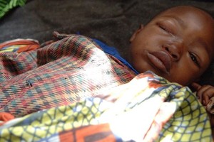 在刚果民主共和国北基伍省，一名患有猴痘的五岁男孩在流离失所者营地的卫生中心休息。（图：联合国）