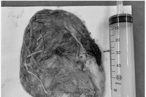 手术团队以腹腔镜手术切除的肺囊肿。（图：S.I.S）