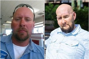 詹姆斯意外前(左图)和手术后(右图)对比图。（图：互联网）