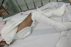 六岁男童严重灼伤疑被毒打