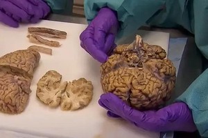 脑中微塑料含量令人震惊。（示意图：互联网）