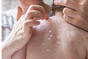 美国麻疹疫情造成两人死亡。（示意图：互联网）