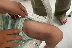 Khởi tố vụ bé gái bị mẹ ruột và người tình bạo hành