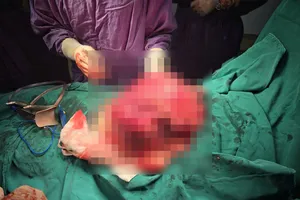 Phẫu thuật lấy khối u xơ tử cung nặng 4kg cho bệnh nhân người nước ngoài