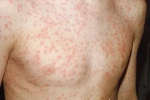 Số người mắc sởi tăng “chóng mặt“