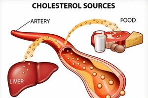 Báo động tình trạng người Việt Nam bị thừa Cholesterol 