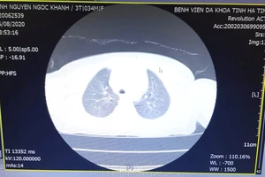 Hình ảnh dị vật thông qua chụp CT- Scanner của bệnh nhi K.