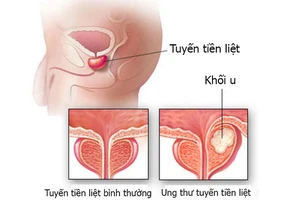 Hơn 1.275 trường hợp mắc mới ung thư tuyến tiền liệt mỗi năm