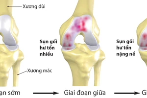 Bệnh nhân thoái hóa xương, khớp ngày càng trẻ hóa