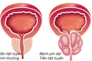 Bí kíp Dứt điểm phì đại tiền liệt tuyến không cần phẫu thuật