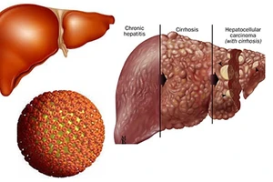 Gần 90% bệnh nhân ung thư gan bị mắc viêm gan B và C