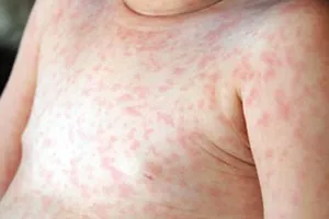 60 trẻ mắc sởi trong tuần đầu tiên của năm 2019