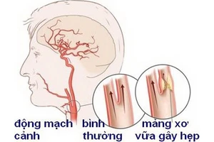 Chớ coi thường bệnh hẹp động mạch cảnh