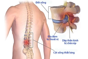 Hiểu để điều trị đúng bệnh lý cột sống