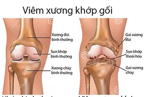 Từ biệt đau đớn do bệnh xương khớp