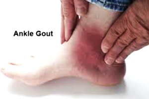 Cách mới chữa trị sỏi thận và bệnh gout