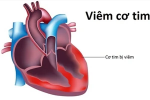 Không tồn tại virus lạ gây viêm cơ tim