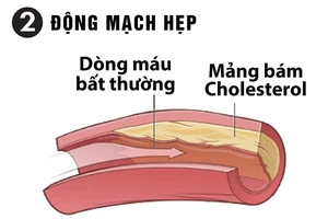 Ổn định huyết áp, tránh xa các biến chứng