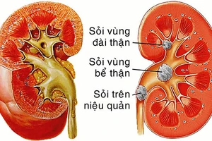 Điều trị sỏi thận không xâm lấn bằng phương pháp tán sỏi ngoài cơ thể