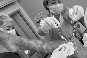 Cứu sống một phụ nữ nhiễm độc toàn thân do dị ứng thuốc