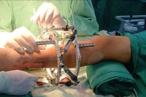 Phẫu thuật kéo chân cho thiếu niên có 2 chân lệch nhau 7cm