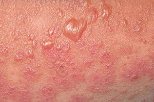 Các mụn nước và bọng nước là các đặc trưng của hội chứng Steven Johnson