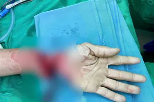 Cổ tay đứt lìa của một bệnh nhân nam. Ảnh: BVĐKKH