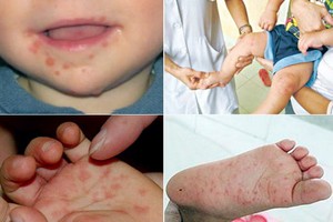 手足口病的表現（圖片來源：互聯網）