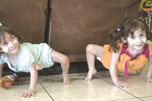 美連體女嬰分離手術後健康成長。（圖片來源：互聯網）