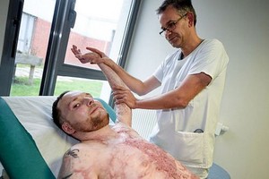 法為燒傷 95% 患者異體植皮手術。