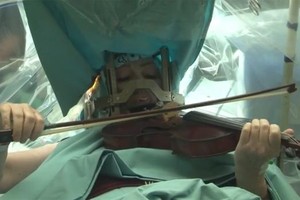 做開顱手術時竟然能拉琴