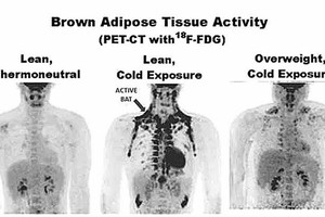 PET/CT掃描，寒冷條件下瘦的人，其肩胛骨等部位褐色脂肪更多。