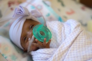 “世界最小存活嬰兒”僅重 245 克