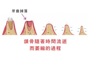 牙齒掉落帶來後果