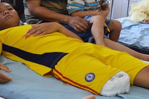 因由醫院處理不當，陳竹江上夾板後截肢三分之一。（圖源：互聯網）