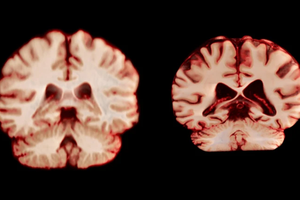 健康大脑（左）和受阿尔茨海默病影响的大脑。