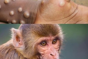 Pharma companies told to proactively develop monkeypox medication