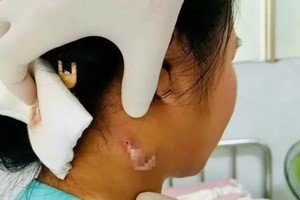 Dong Nai reports case of flesh-eating bacteria