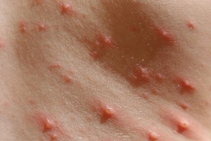 Vietnam cooperating with WHO to closely monitor monkeypox