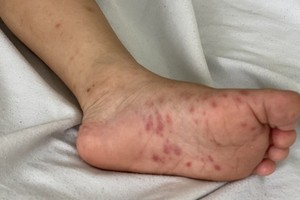 HCDC identifies genotype of EV71 causing severe hand-foot-mouth disease